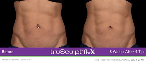 Trusculpt Flex Twickenham Thames Skin Clinic Redefining Muscle