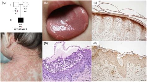 An Infant With Generalized Pustular Psoriasis And Geographic Tongue Had