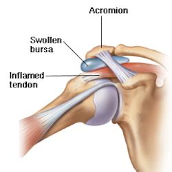 I haven't assessed you in person so it might be hard to give you specific. Shoulder Tendinitis Causes & Treatment | Cleveland Clinic ...
