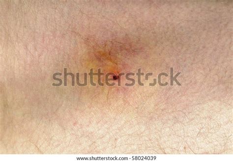 Infected Tick Bite On Thigh Stock Photo 58024039 Shutterstock