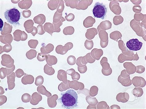 Hairy Cell Leukemia 1