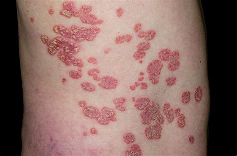 Plaque Psoriasis On The Skin Photograph By Dr P Marazzi Science Photo