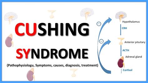 Cushing Syndrome Causes Clinical Features Diagnosis Treatment