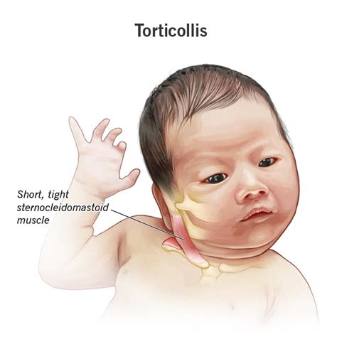 Torticollis Wryneck Symptoms Causes And Treatment