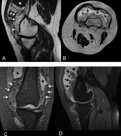 Lipoma Arborescens Of The Knee Joint Bmj Case Reports