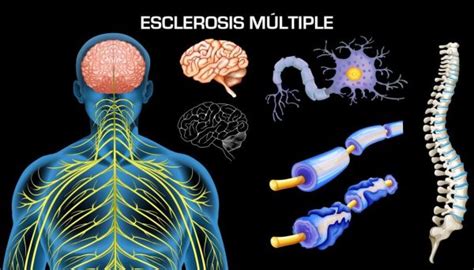 Tengo esclerosis múltiple, pero nadie se daría cuenta con solo mirarme. ¿Esclerosis múltiple, qué es? | enfermedad del sistema ...