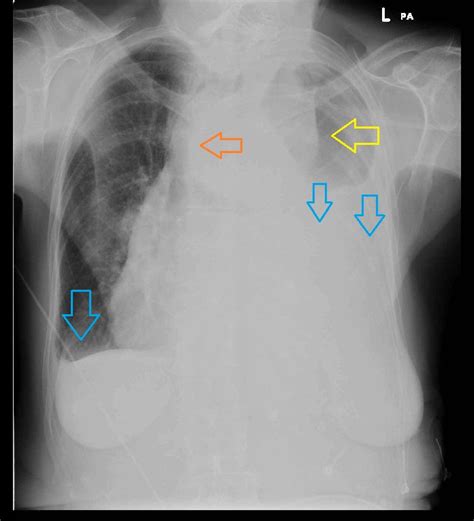 Aortic dissection (ad) occurs when an injury to the innermost layer of the aorta allows blood to flow between the layers of the aortic wall, forcing the layers apart. Aortic dissection x ray - wikidoc