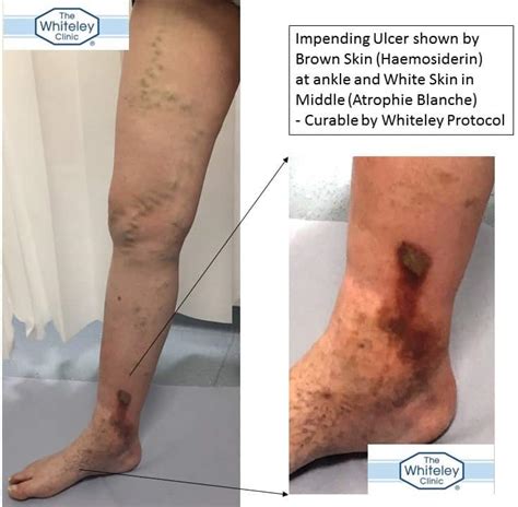 List 90 Wallpaper Photos Of Varicose Veins In Legs Updated