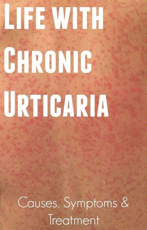 Chronic Urticaria Ciu Urticaria Chronic Hives Hives Remedies