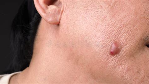 Big Acne Cyst Abscess Or Ulcer Swollen Area Within Face Skin Tissue Stock Photo Image Of Dirty