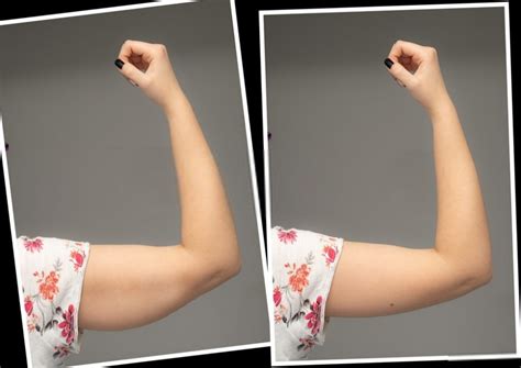 How To Get Rid Of Underarm Fat Quickly Safe And Easy Myhealthpals