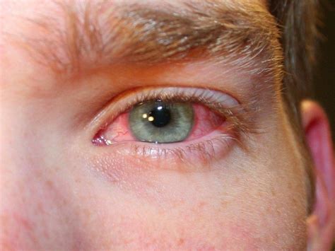 Irritated Eyes Causes Types Of Conditions Symptoms And Treatment