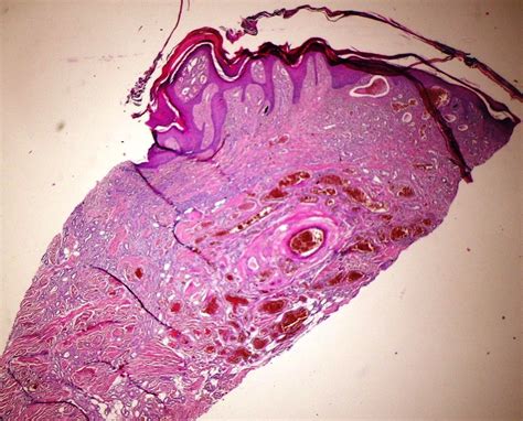An Unusual Vascular Tumor Verrucous Hemangioma