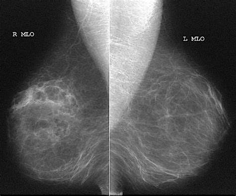 Normal Bilateral Mammogram Mediolateral Oblique Or Mlo Views There
