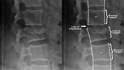 Trauma X Ray Axial Skeleton Gallery 2 Lumbar Spine Fracture Stability