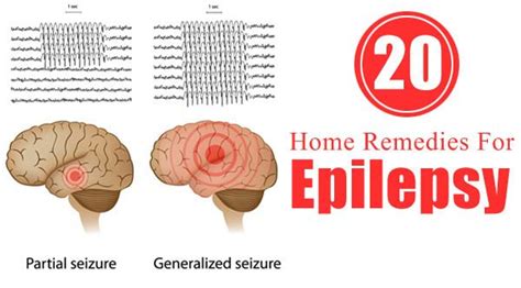 Home Remedies For Epilepsy Epilepsy Remedies