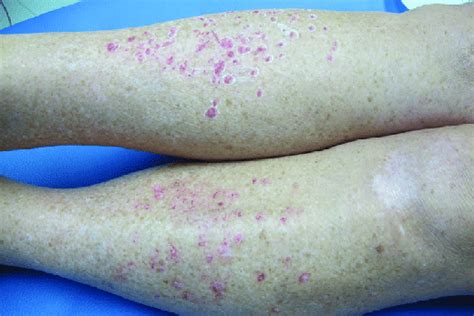 Limbs Of Patient With Idiopathic Guttate Hypomelanosis Lesions Right