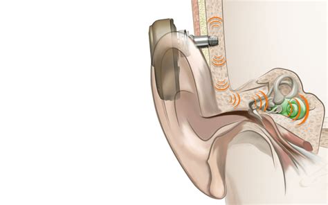 Unlike conventional hearing aids, bone conduction devices do not plug the ear canal and do not block out ambient sounds. Bone-anchored hearing systems: What you need to know