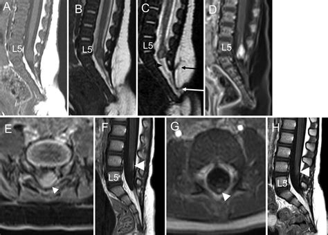 Limited Dorsal Myeloschisis Associated With Intramedullary Infantile