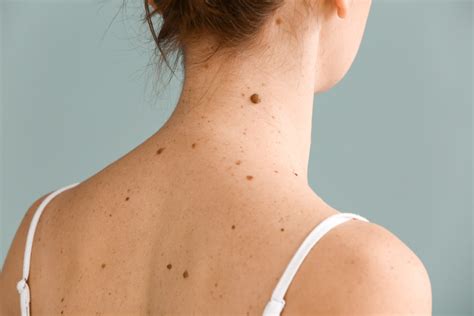 How To Identify Skin Cancer From Moles Bumps And Other Marks