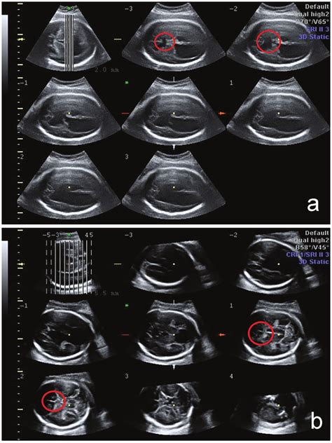 3d Fetal Cns Evaluation With Tomographic Ultrasound Imaging Tui The