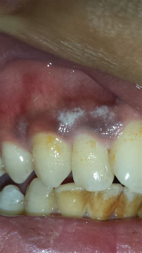 Cause Of White Gums Medizzy