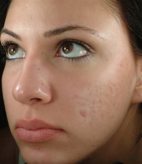 Albums 92 Background Images Pictures Of Acne Scars Updated