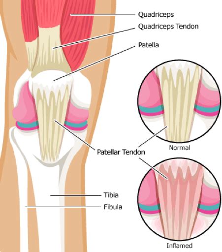 Knee Tendonitis Treatment Nyc Patellar Tendonitis Doctors Manhattan