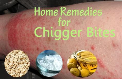 21 Best Home Remedies To Get Rid Of Chigger Bites Soon