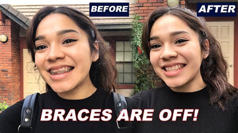 SHE FINALLY GETS HER BRACES OFF SATISFYING YouTube