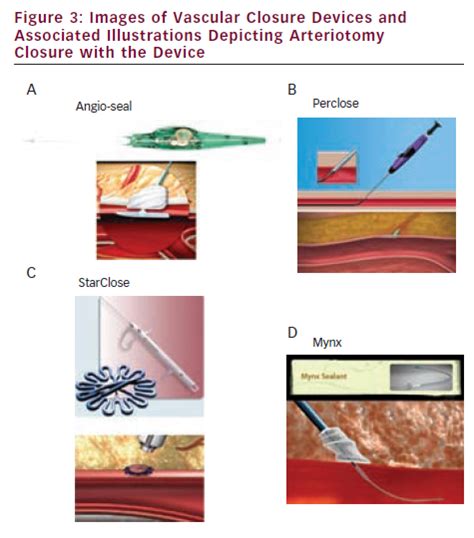 Images Of Vascular Closure Devices And Associated Illustrations