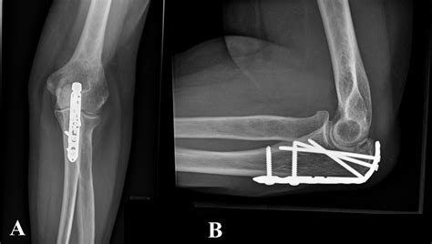 Cureus Olecranon Fracture In An Older Adult Treated With Locking