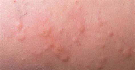 Hives Urticaria Treatment Dermatology Consultants Of South Florida