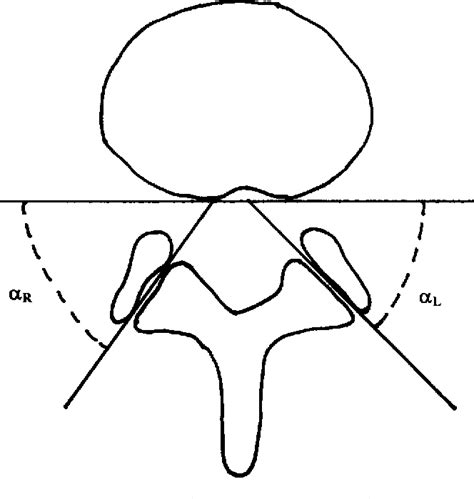 Figure 1 From A Comparison Between Far Lateral And Posterolateral