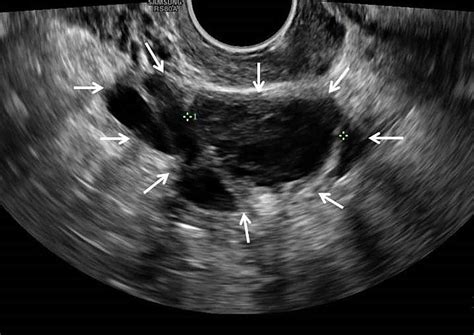 Cureus A Missed Diagnosis Of Ovarian Torsion In A Patient With Bilateral Ovarian Dermoid Cysts