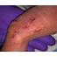 Bullous Lesions In A Neonate  MDedge Dermatology