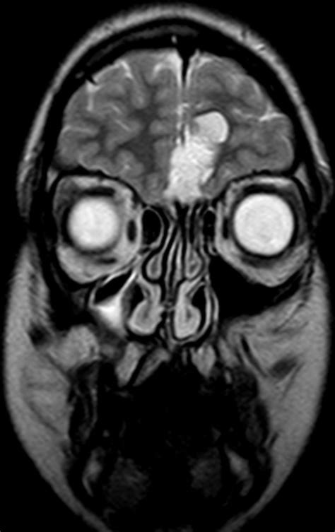 Dermoid Cyst Bridge Of Nose