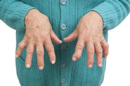 Choroba zwyrodnieniowa stawów palców rąk objawy i leczenie