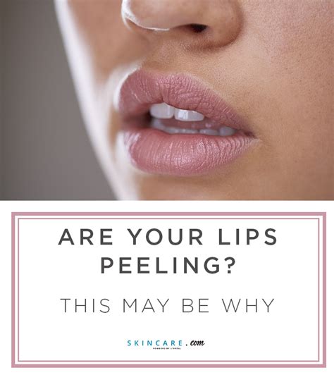 Why Are My Lips Peeling Heres How To Treat Dry Peeling Lips Lips