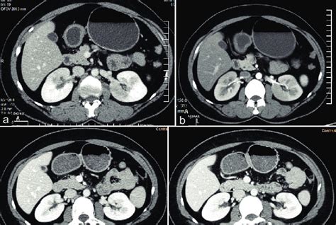Shows Contrast Enhanced Computed Tomography Cect Of Abdomen A And