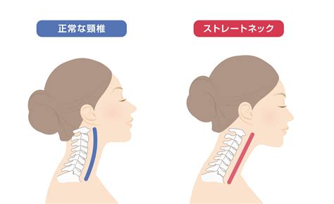 ストレートネックの治し方を徹底解説改善や予防の仕方についてご紹介 月辰会活法整体院