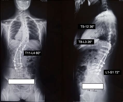 Post Operative Standing Anteroposterior And Lateral Radiographs