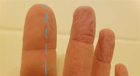 Severed A Nerve In My Index Finger Half My Finger Can No Longer