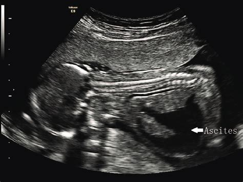 The Sonographic Examination Of Case 2 At 16 Weeks Gestation No