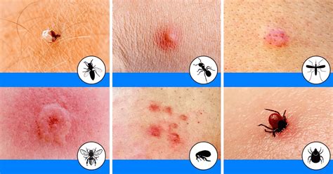 Dikkat Etmeniz Gereken 10 Böcek Isırığı - Bilgecafe