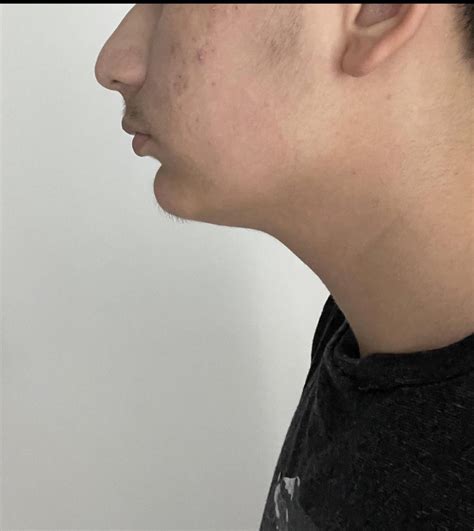 M23 56 120 Lbs Uneven Jaw My Face Is Pretty Asymmetric Is There Any