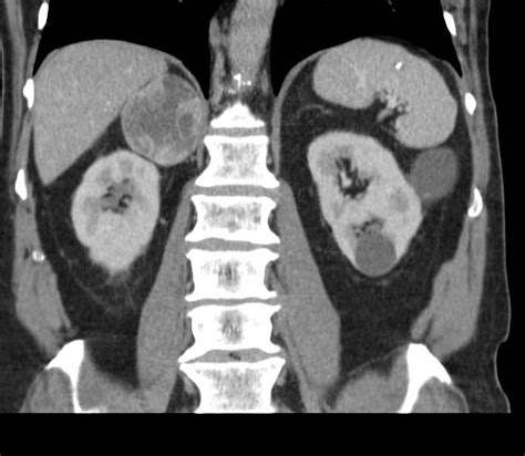 Pheochromocytoma Right Adrenal Gland Adrenal Case Studies Ctisus Ct
