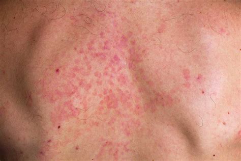 Pityriasis Versicolor Treatment Clear Skin Clinic