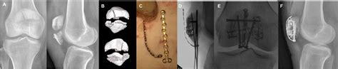 Miniplate Osteosynthesis In Fracture Surgeries Case Series With Review Of Concepts Injury