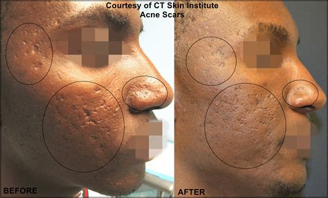 Acne Scar Treatment Connecticut Skin Institute